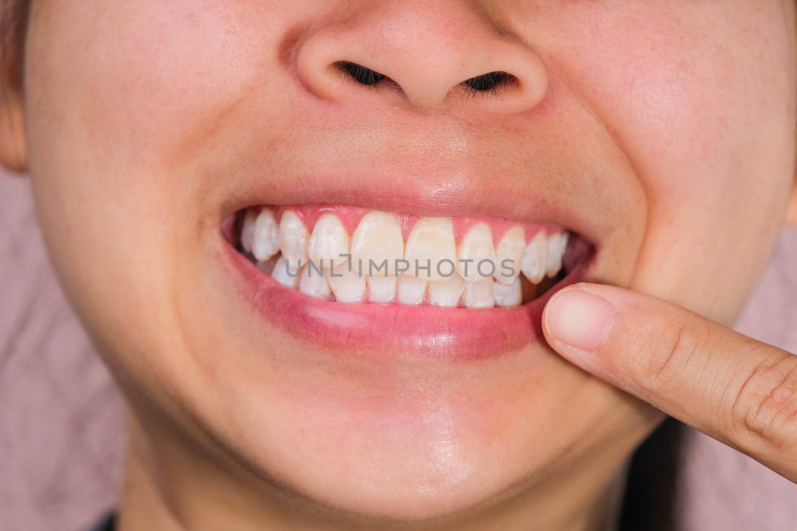 Close up of mouth of happy Asian woman touching the corners of her mouth with index finger while smiling broadly revealing her beautiful white teeth isolated on pink background. by TEERASAK