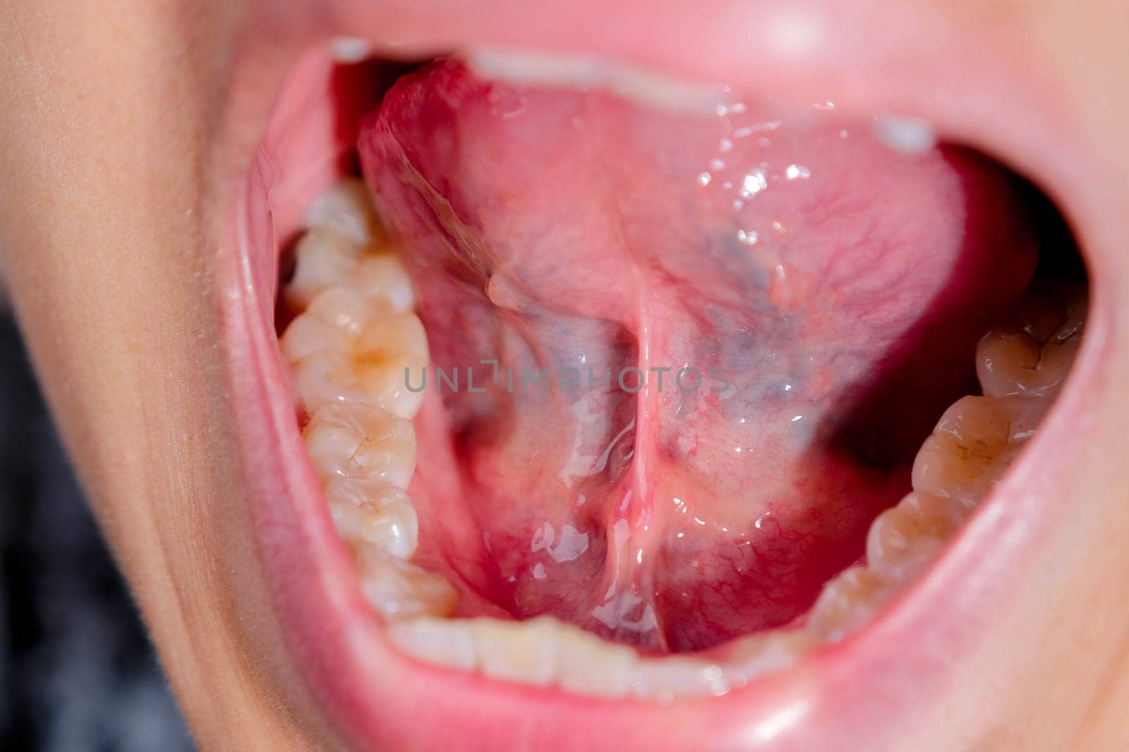 Close-up of the lower jaw, hard palate, soft palate, teeth and gums of a middle-aged woman. by TEERASAK