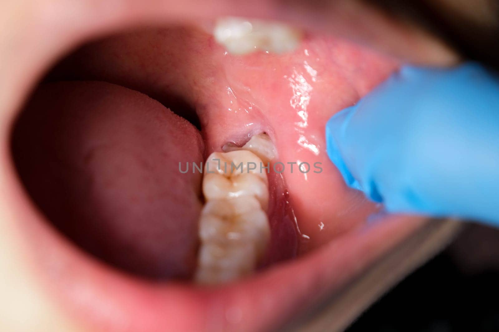 Wisdom teeth affect and cause gum recession. by TEERASAK