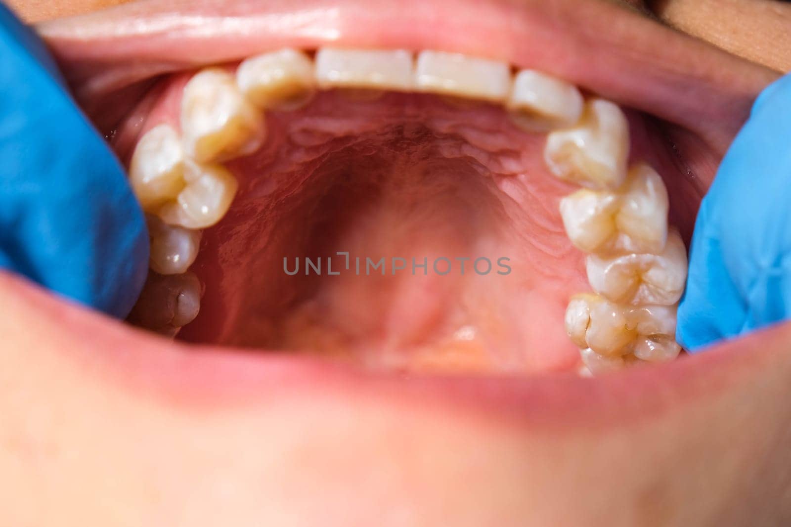 Close-up of the upper jaw, hard palate, soft palate, teeth and gums of a middle-aged woman.