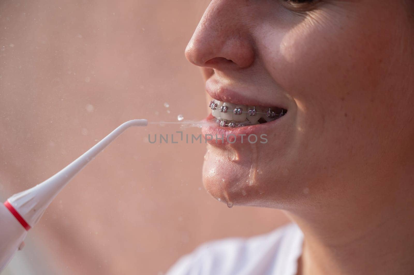 A woman with braces on her teeth uses an irrigator. Close-up portrait. by mrwed54