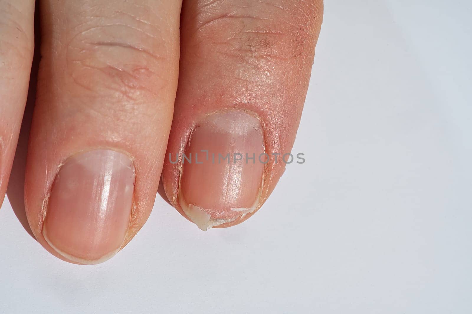 Close-up of brittle nails on woman's hands. Female broken fingernail. weak sore nails.