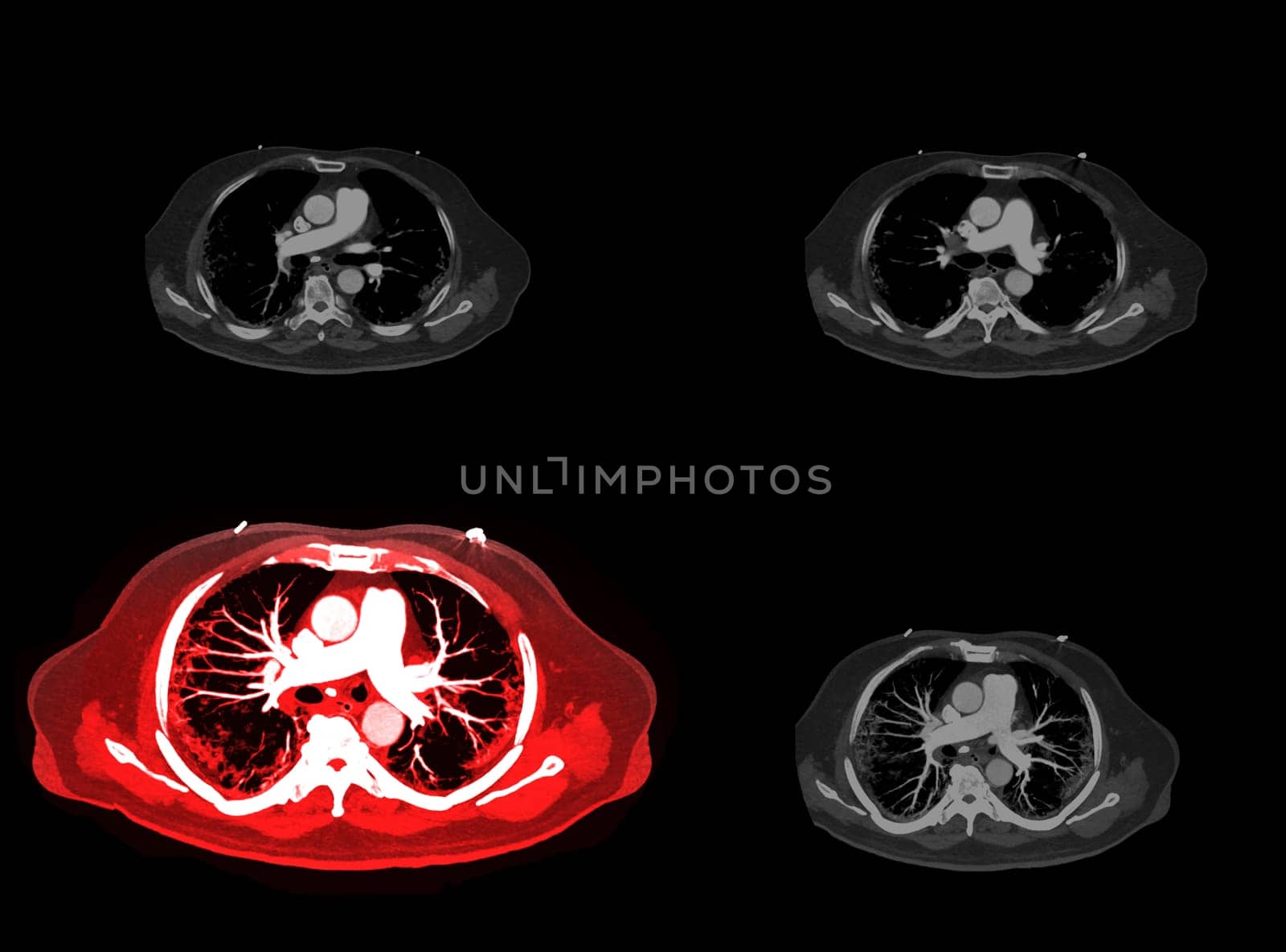 CTA pulmonary arteries 3D rendering showing branch of pulmonary artery