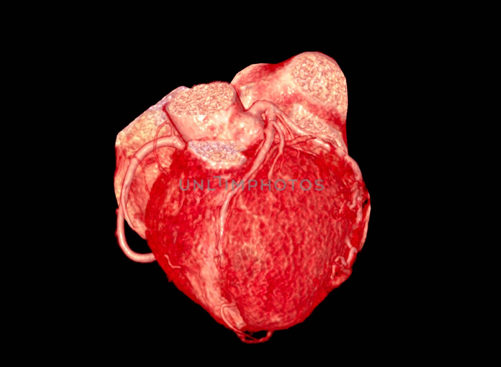 CTA Coronary artery 3D rendering image.