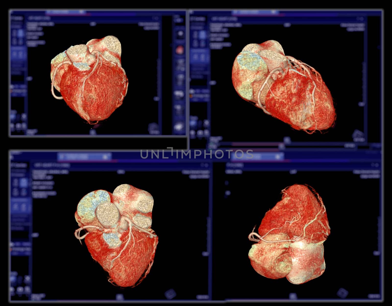 CTA Coronary artery 3D rendering image.