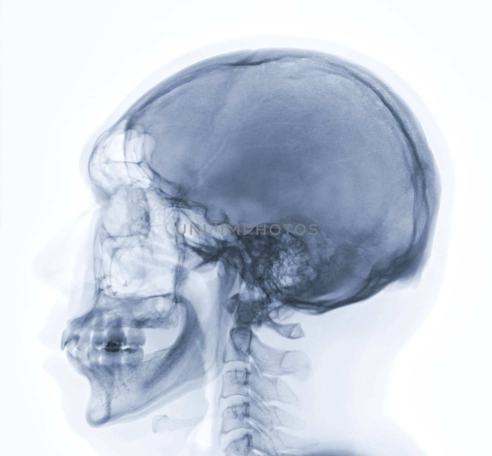 x-ray image of Human Skull lateral view for diagnosis skull fracture isolated on Black Background. by samunella