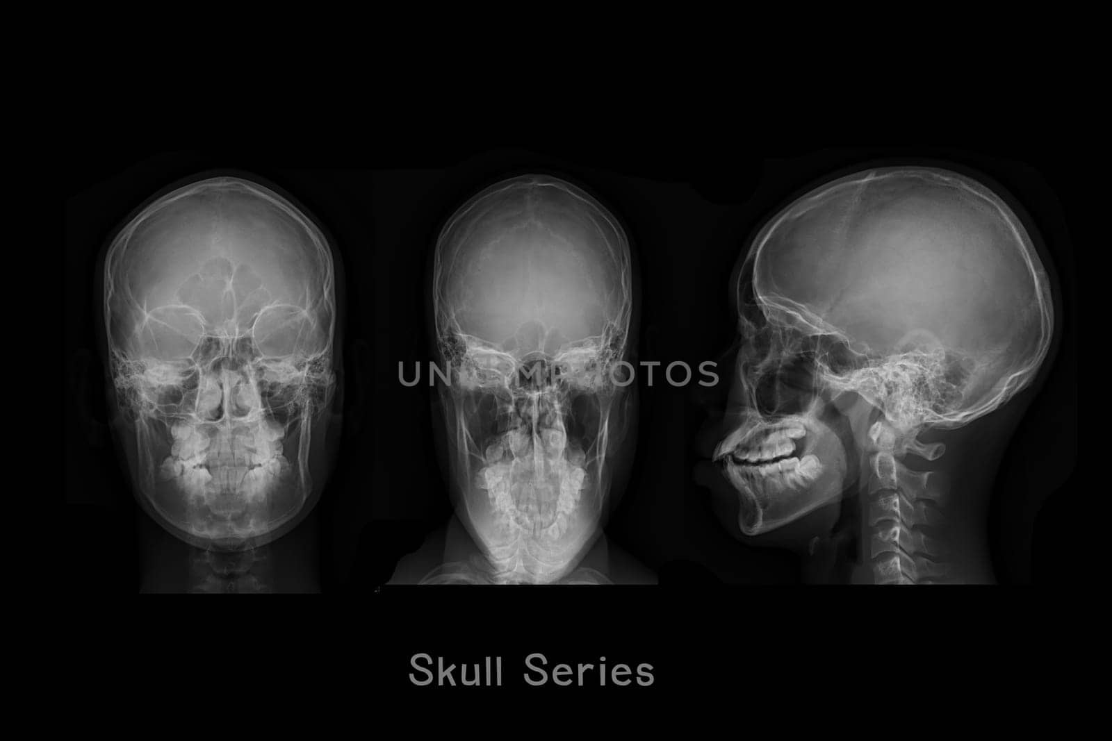 x-ray image of Skull AP,Town's and Lateral view or Skull series for diagnosis skull fracture isolated on Black Background.