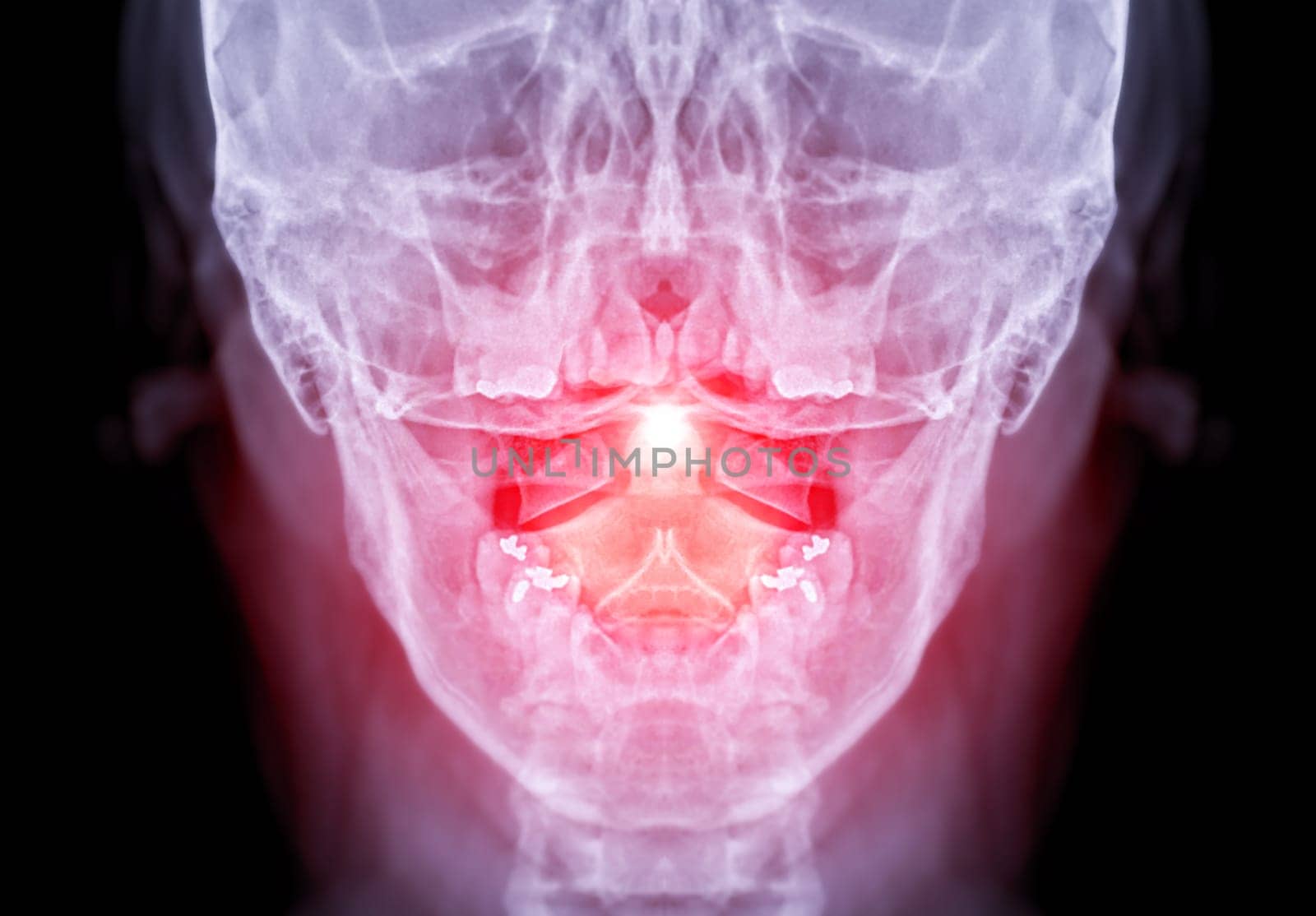 X-ray C-spine or x-ray image of Cervical spine open mount view for fracture of cervical vertebra 2nd ( axis ).