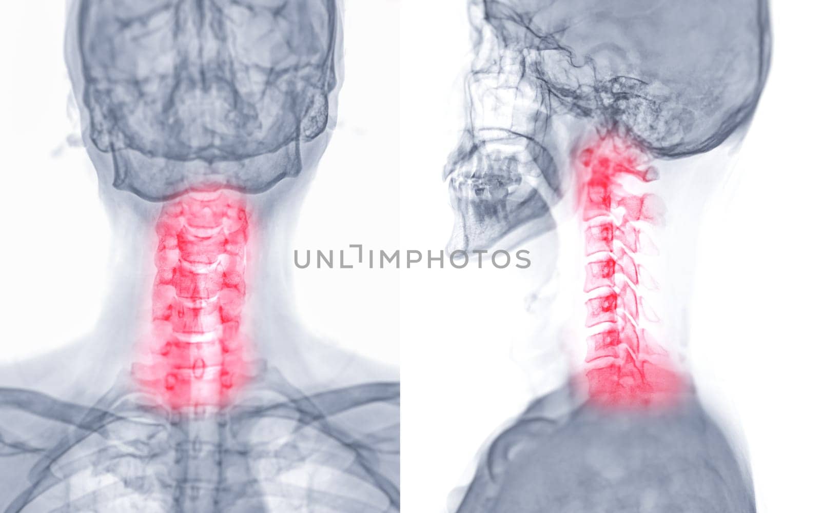 X-ray C-spine or x-ray image of Cervical spine AP and Lateral view for diagnostic intervertebral disc herniation ,Spondylosis and fracture. by samunella