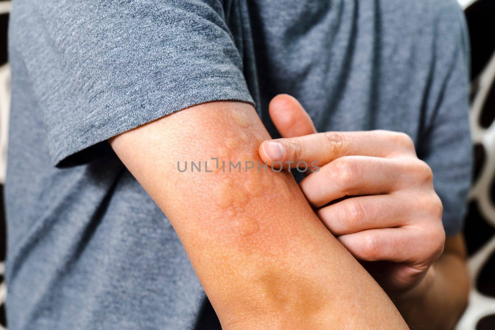 Skin rash and swelling on man arm, immunizations prevent infectious disease in human