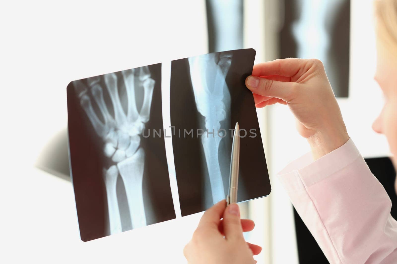 female doctor looks at x-ray of a arm injury in hospital. Sequelae of hand injuries and arthritis