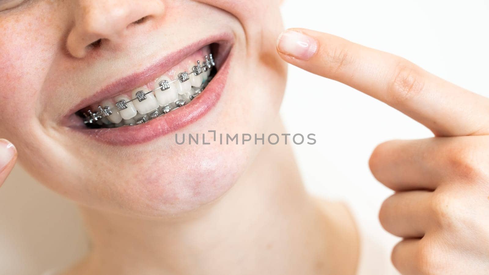 Close-up portrait of a young woman pointing at a smile with braces on her teeth