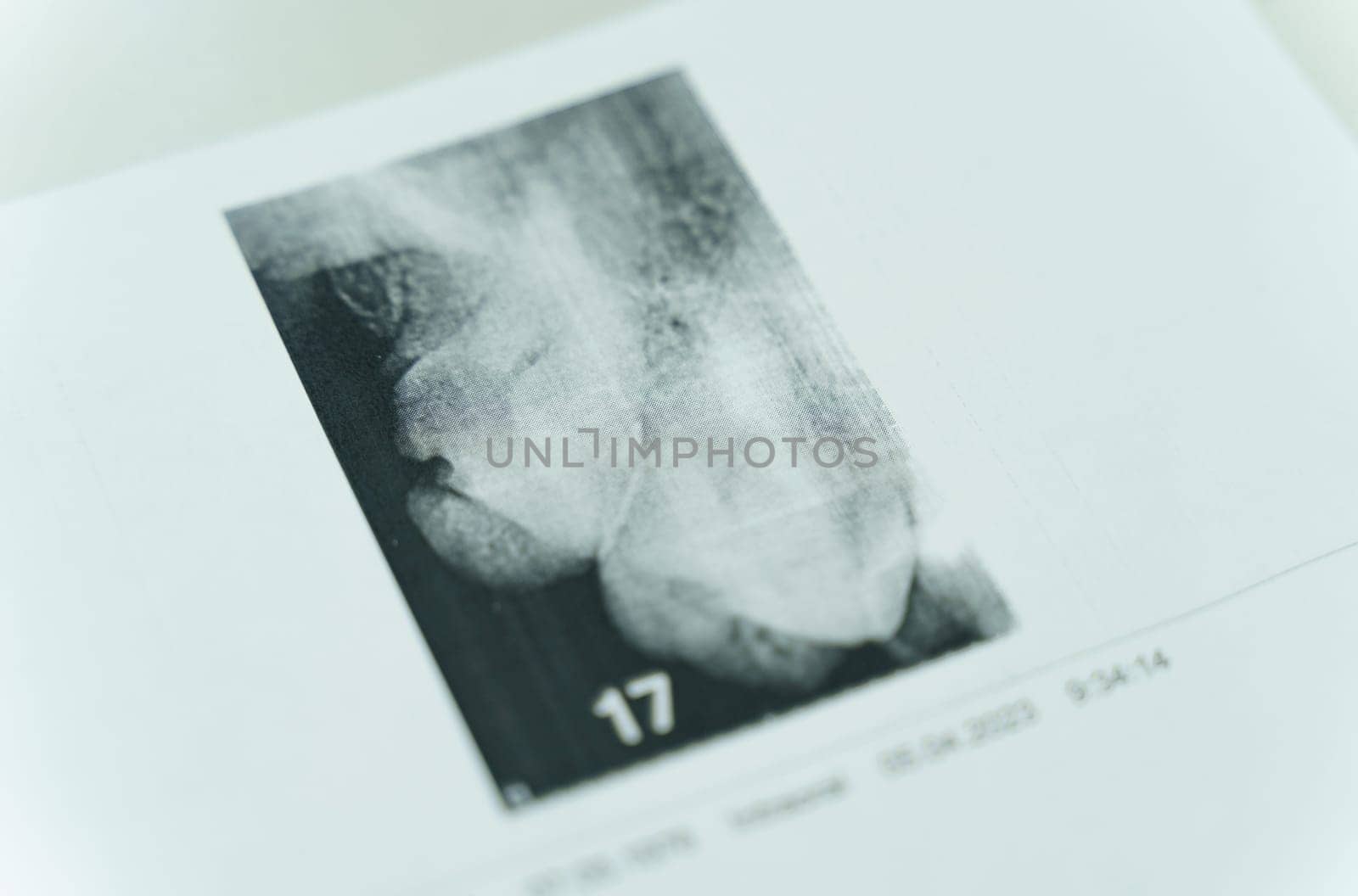 On the table is a close-up printout of two teeth.