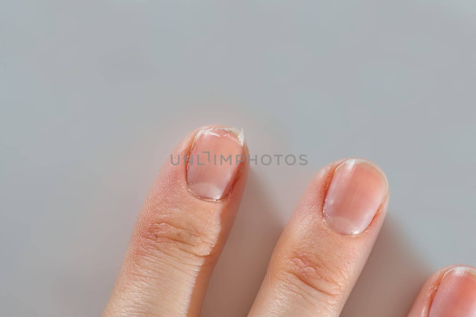 Close-up of brittle nails on woman's hands. Female broken fingernail. weak sore nails.