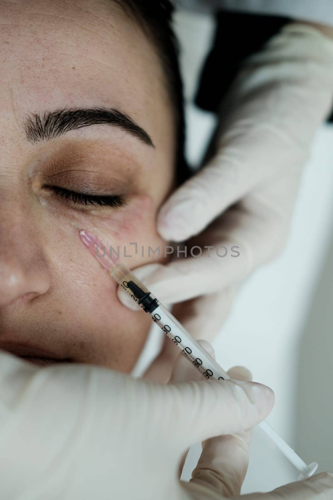 Cosmetologist applying eye mesotherapy to female patient. Eye mesotherapy procedure. Serum being applied in the undereye area via a syringe.
