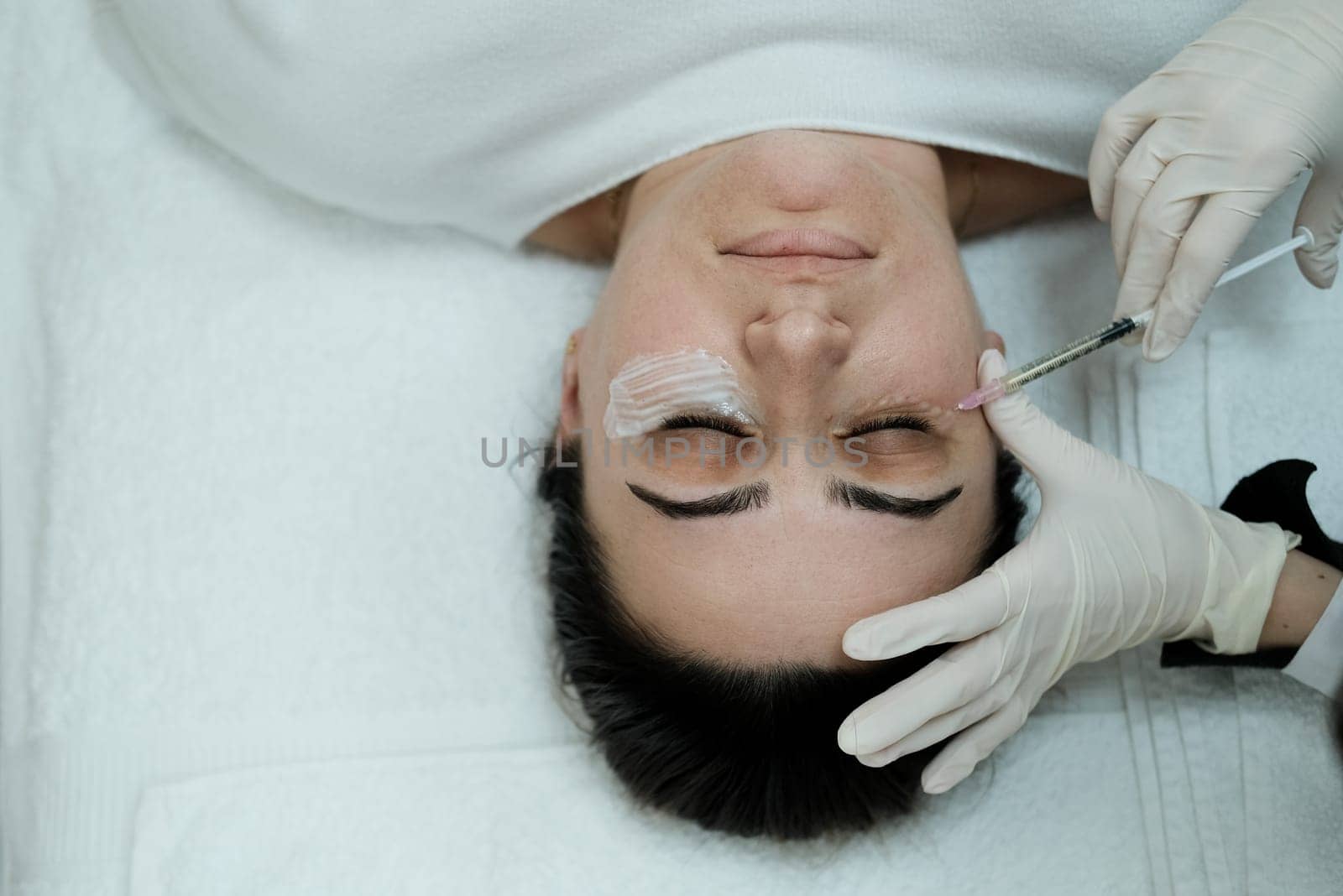 Top view of female patient having eye mesotheraphy applied. Eye mesotherapy procedure. Serum being applied in the undereye area via a syringe.