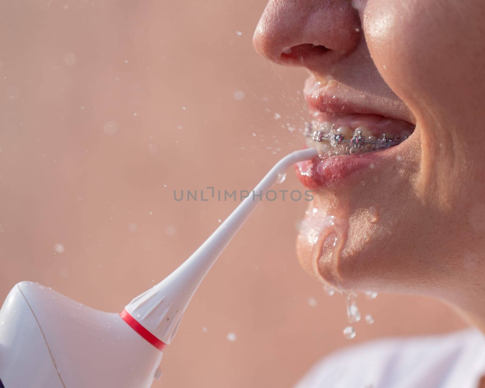 A woman with braces on her teeth uses an irrigator. Close-up portrait