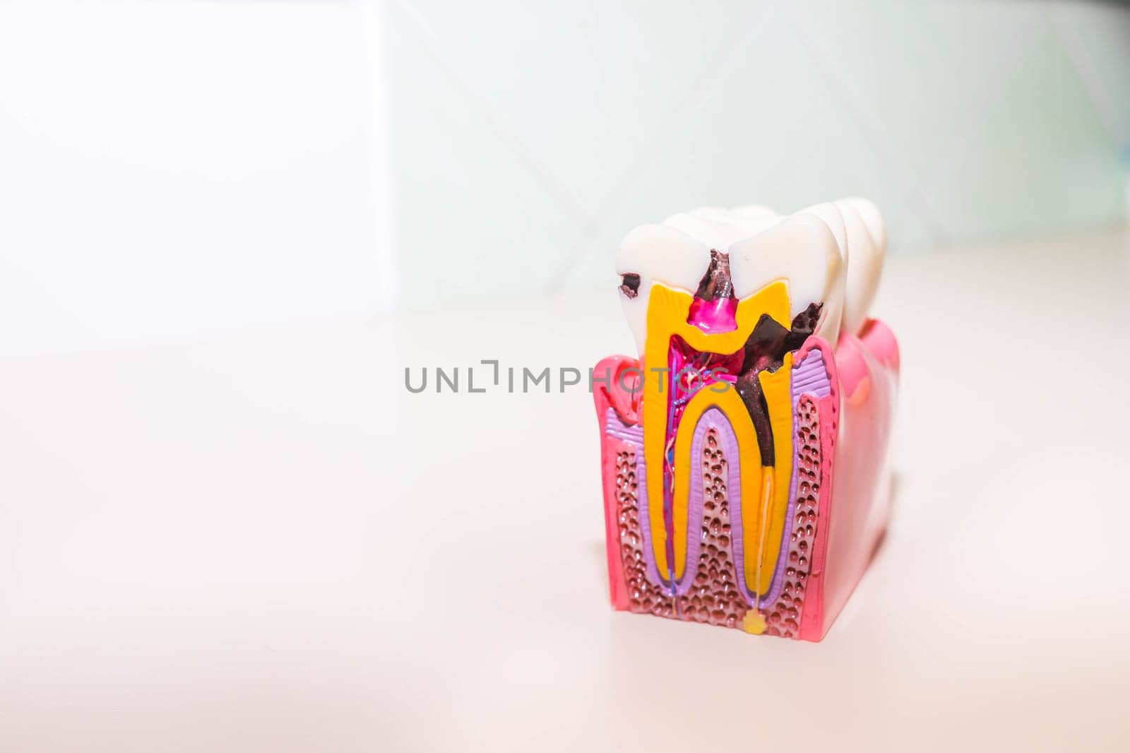 tooth model with caries, tooth decay in dentist's office. Healthy teeth concept . Big tooth model with details on the nerve, dentin, enamel, cavities and abscesses, dental diseases.Copy space by YuliaYaspe1979