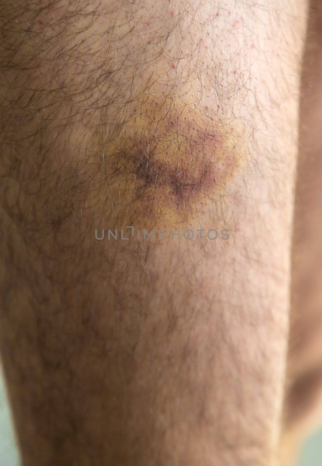a bruise on a man's leg. Selective focus. people.
