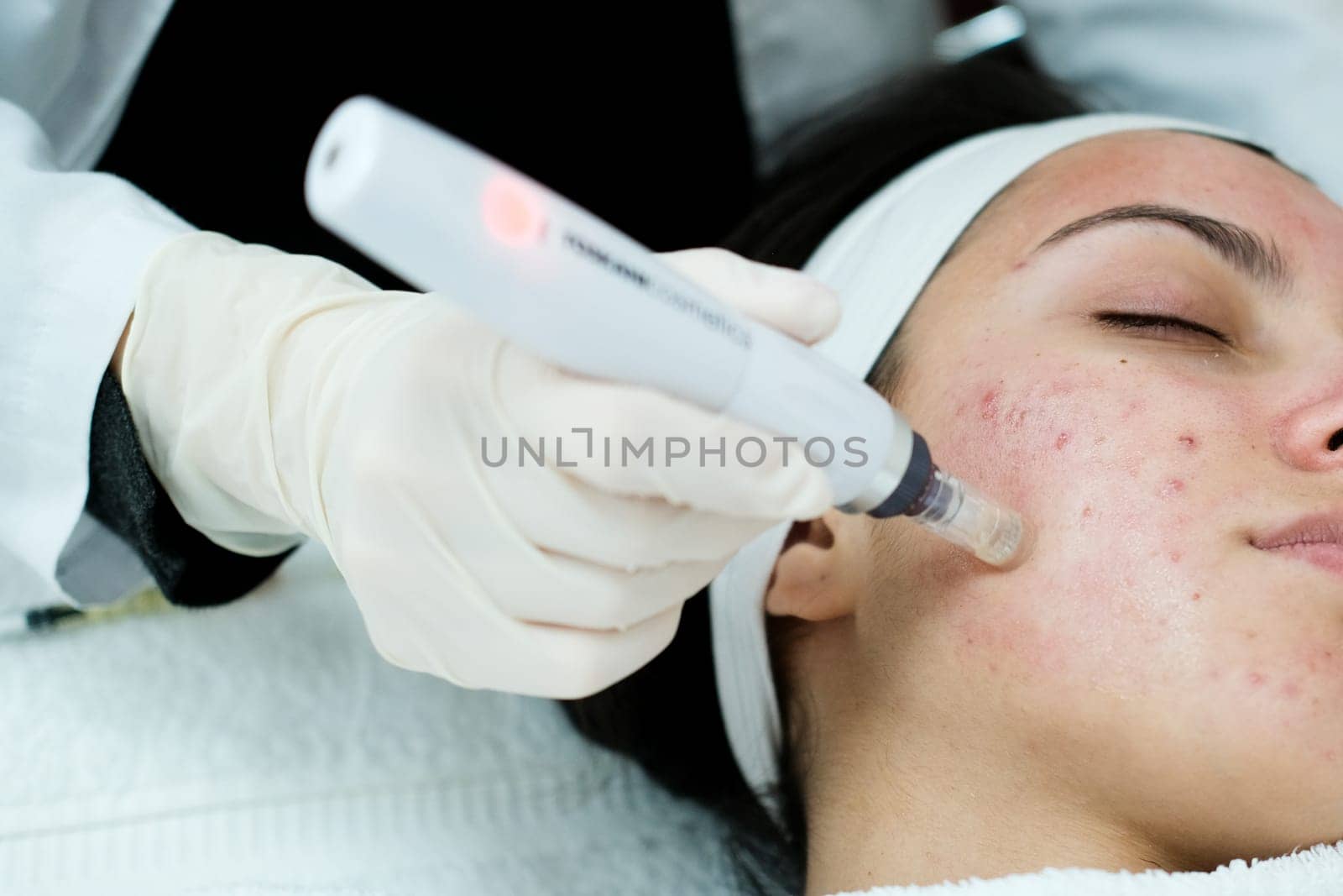 Closeup view of woman having microneedling procedure applied on her face by danjelaruci