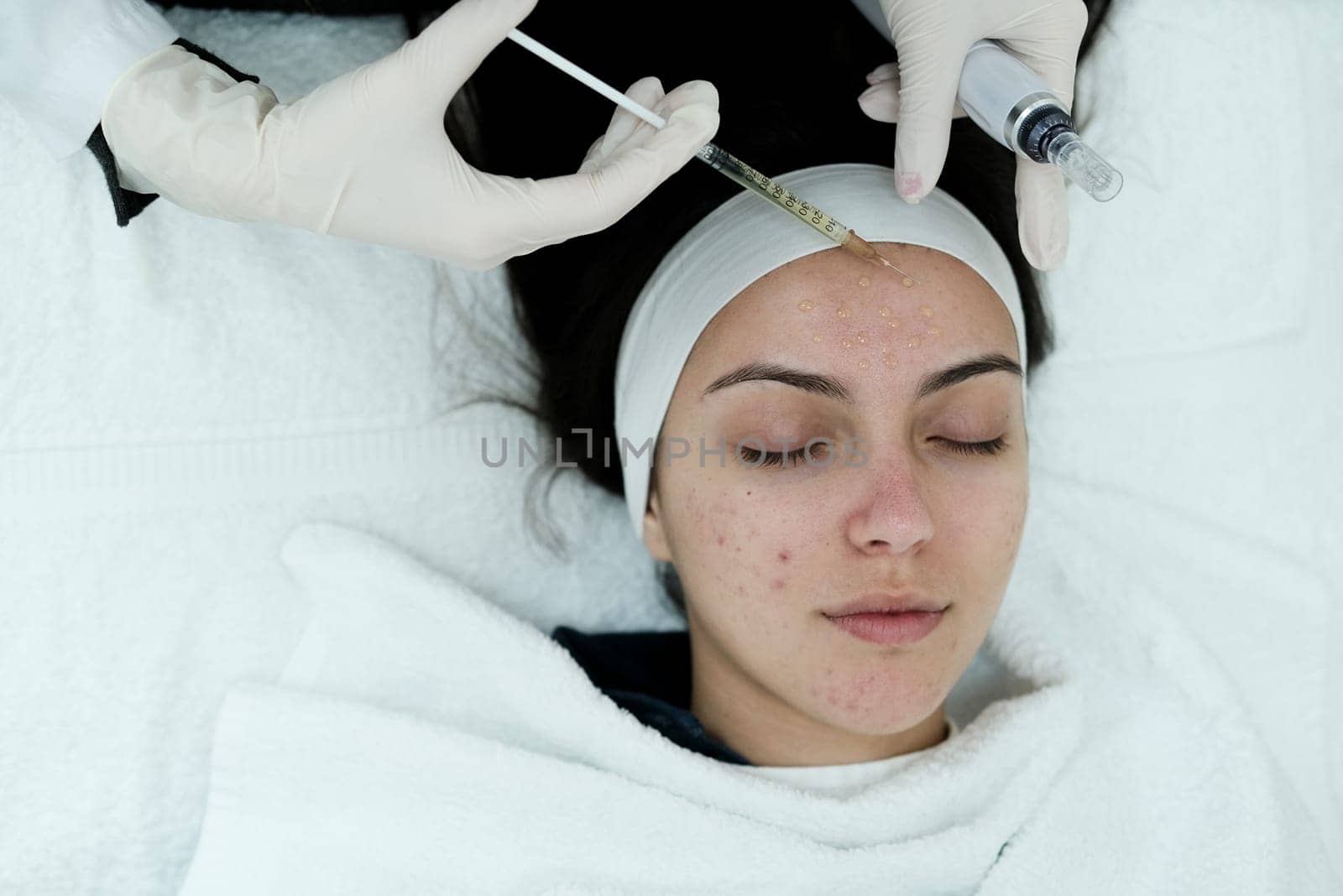 Cosmetologist applying mesotherapy serum. Preparing skin for microneedling procedure. Caucasian.