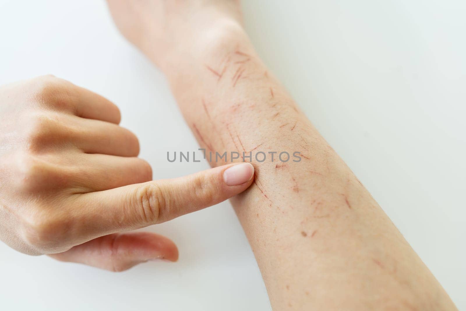 The doctor examines the hand, the person is scratched all over, dry skin on the hand, wounds on the hand, scars, psoriasis vulgaris, eczema or other skin diseases. Miscellaneous autoimmune genetic disease. by sfinks