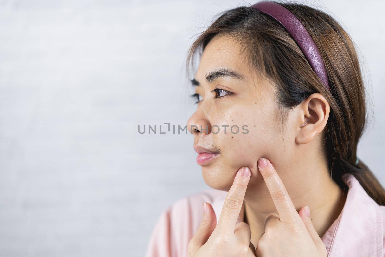 Young woman with acne problem on gray background