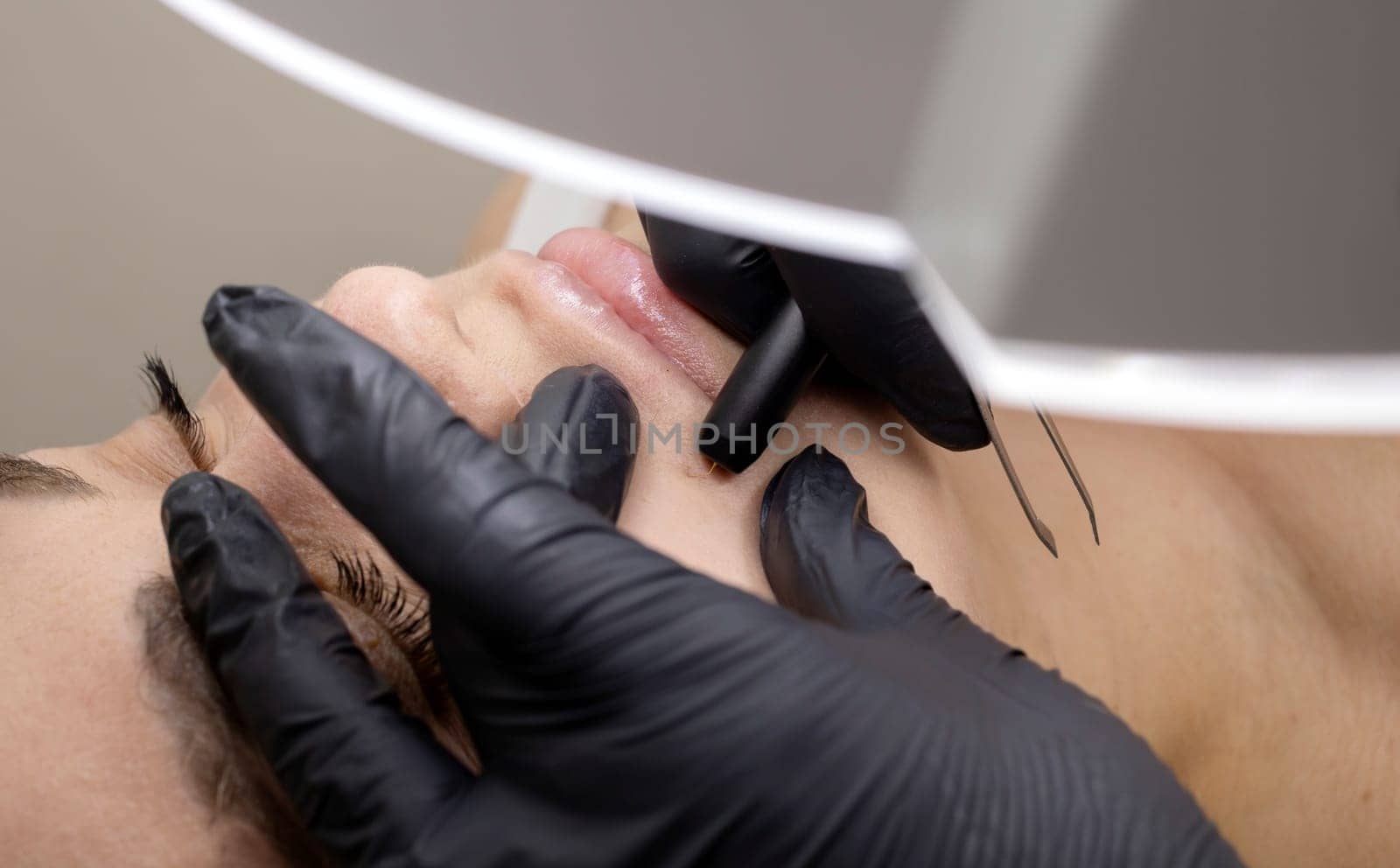 Dermatologist Removes Hair Above Lips On Woman's Face With Electrolysis. Electric Epilation In Beauty Salon, Unrecognized Patient. Horizontal Plane. Authentic Photo by netatsi