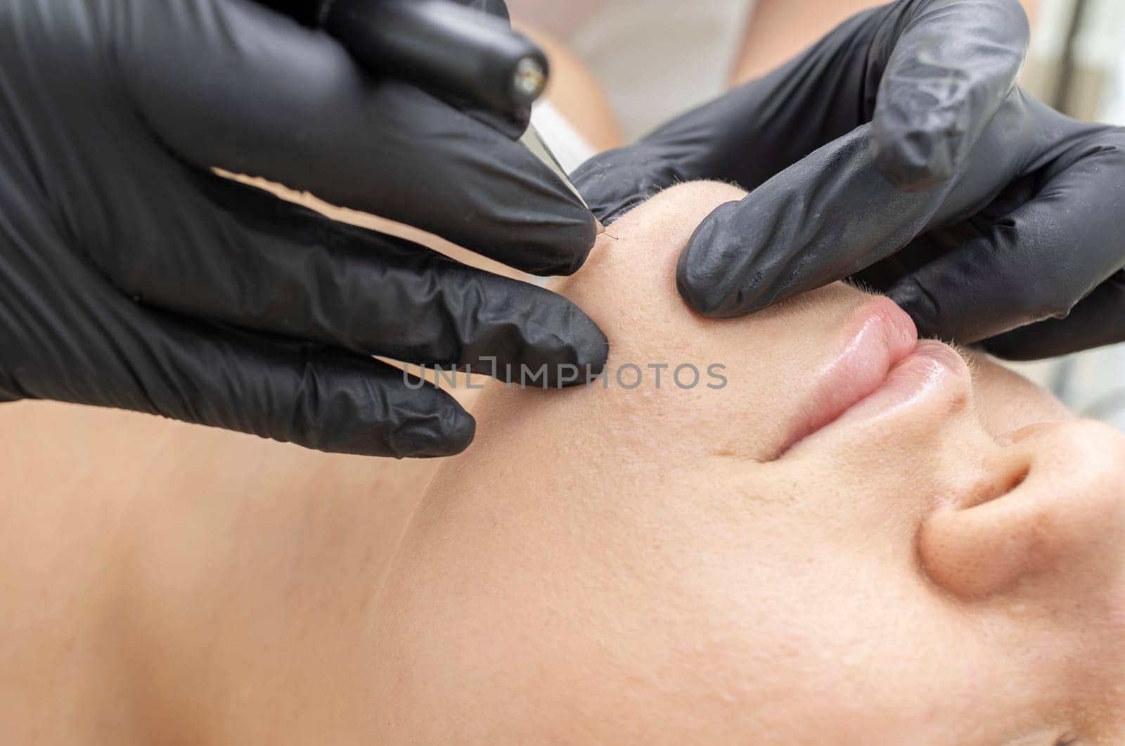 Closeup Dermatologist Pulling Hair On Chin Of Patient's Face With Tweezers, Electrolysis Procedure, Electric Epilation In Beauty Salon. Hair Removal Treatment. Horizontal Plane High quality photo