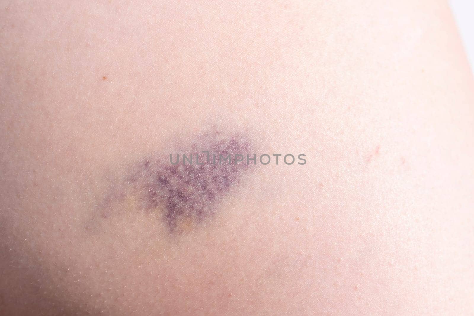 Closeup Blue Purple Hematoma, Bruise On Thigh, Hip After Trauma, Fall. Horizontal plane. Clotted Blood, Injury On Human Body Concept. High quality photo