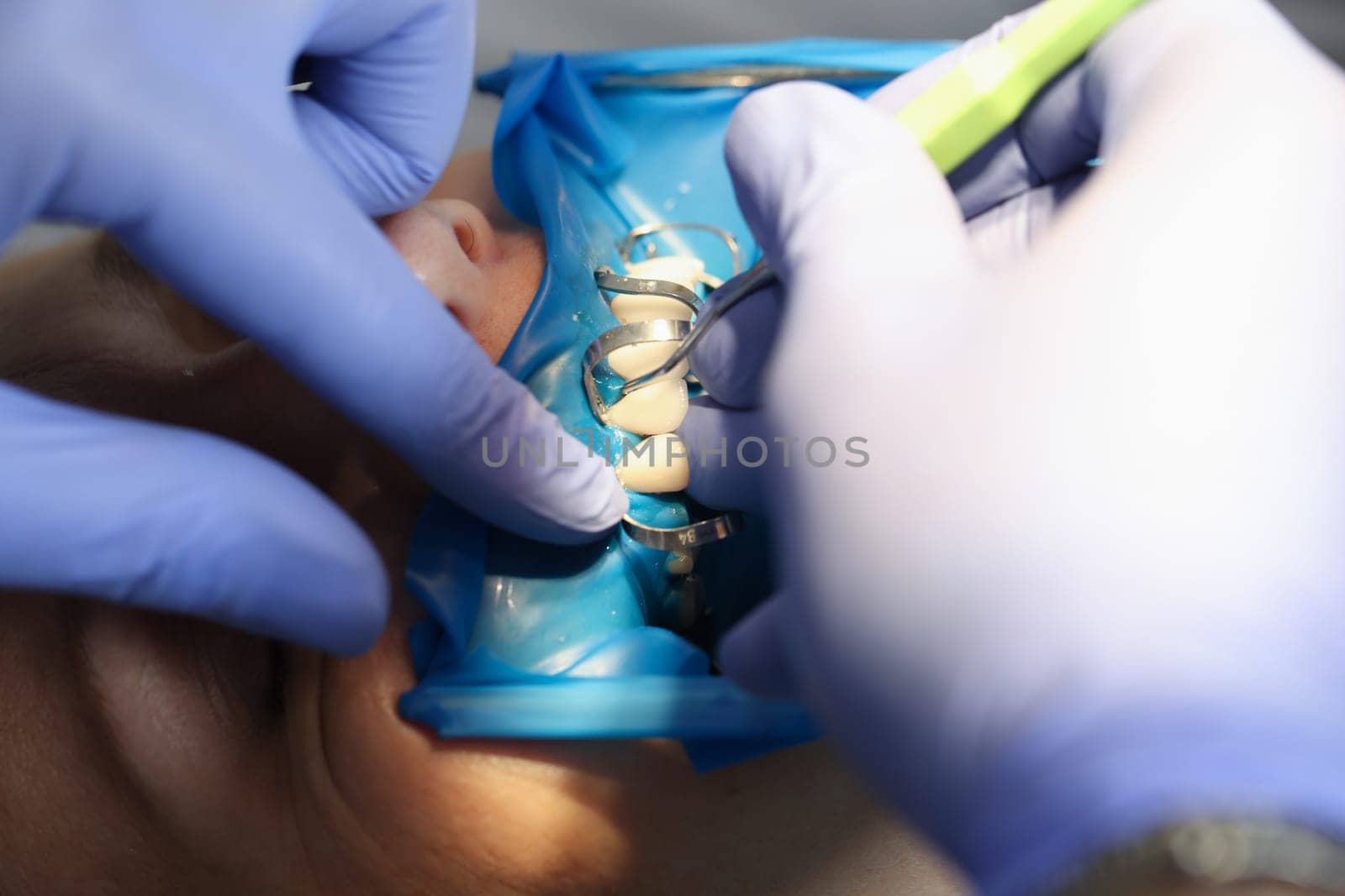 Doctor dentist fixing veneer on patient teeth using metal tools closeup. Prosthetics in dentistry concept