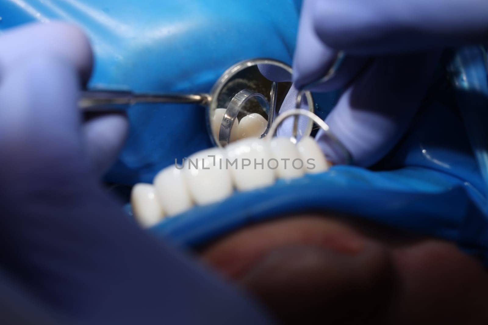 Doctor dentist installing veneers on patient teeth using metal tools closeup by kuprevich