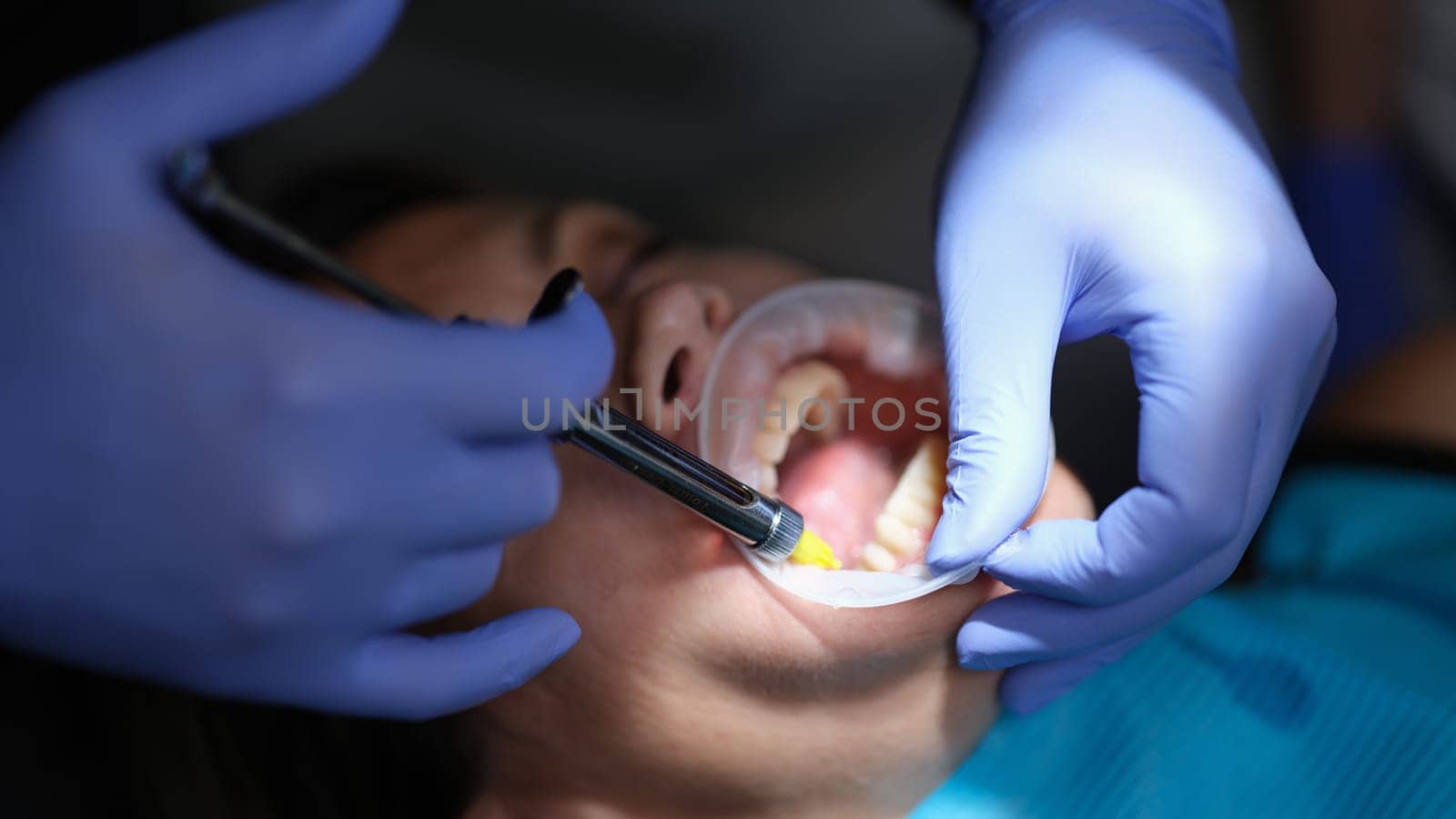 Dentist doctor applying adhesive for veneers and prosthetics in clinic closeup. Anesthesia in dentistry concept