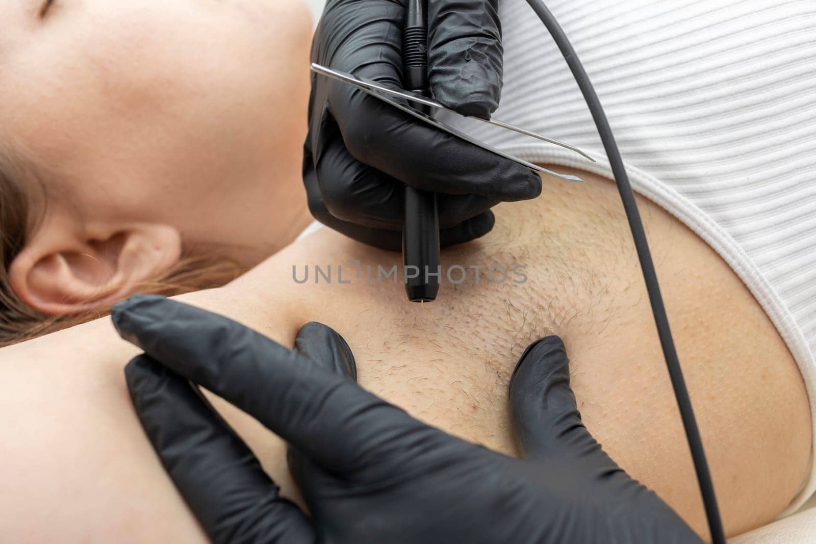 Closeup Dermatologist Removing Hair On Patient's Underarms With Electrolysis Procedure, Electric Epilation In Beauty Salon. White Customer Is Lying On Couch. Horizontal Plane. Hair Removal Treatment.