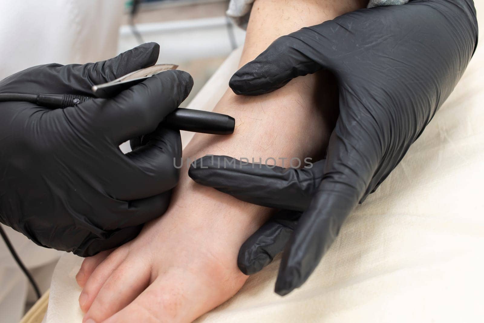 Closeup Process Of Permanent Unwanted Hair Removal On Foot, Toe, Using Electroepilation Device And Tweezers. Horizontal Plane. High quality photo