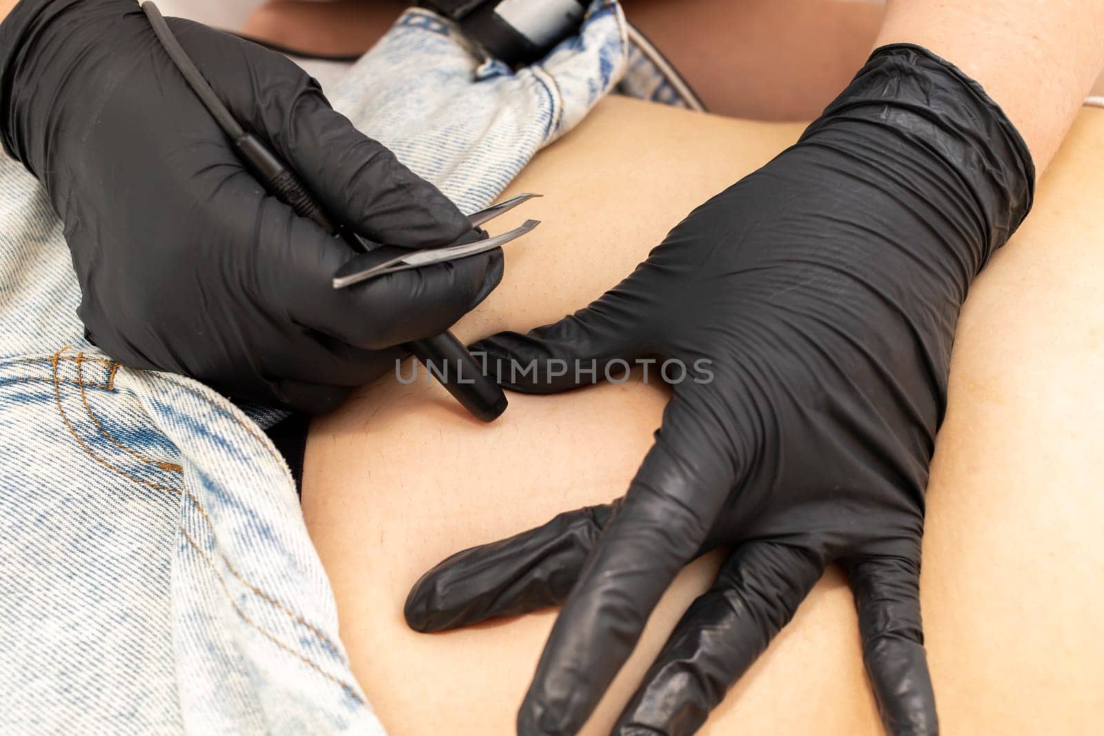 Hirsutism. Cropped Dermatologist Removes Hair On Woman's Belly, Abdomen With Electrolysis Procedure, Electric Epilation In Beauty Salon. Horizontal Plane. Authentic Photo