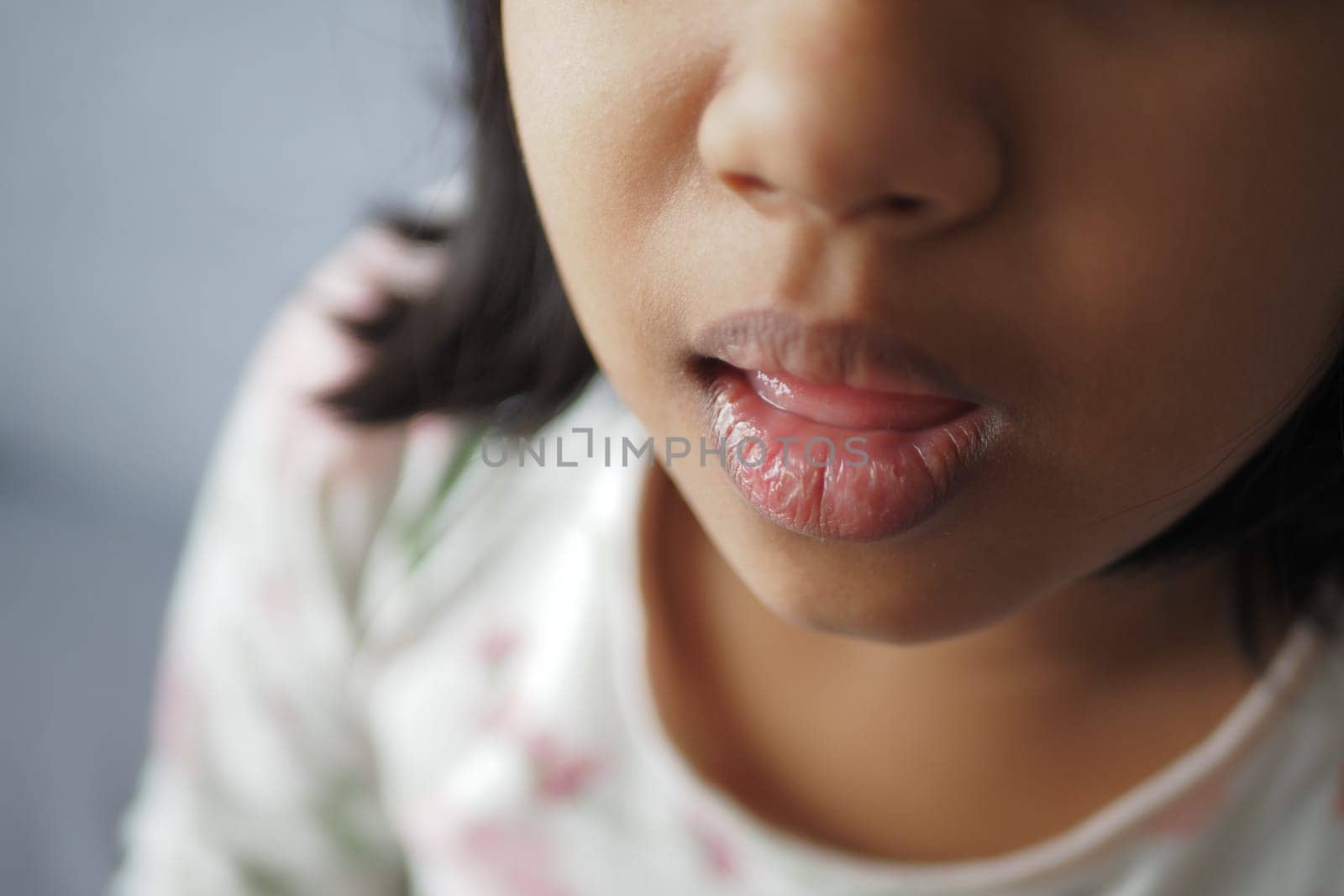 closeup of dry lip of a baby ,