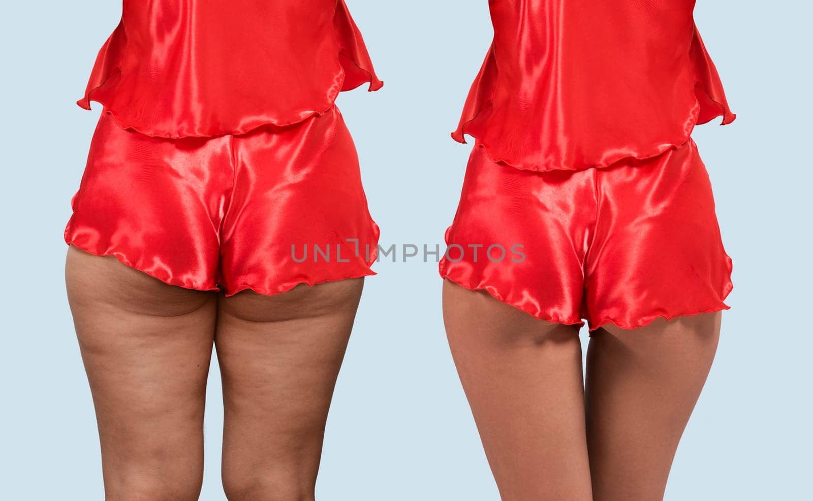 Woman's thighs and buttocks with cellulite. Before and after treatment. Concept of excess weight, diet, sports and needing Improving the skin on legs