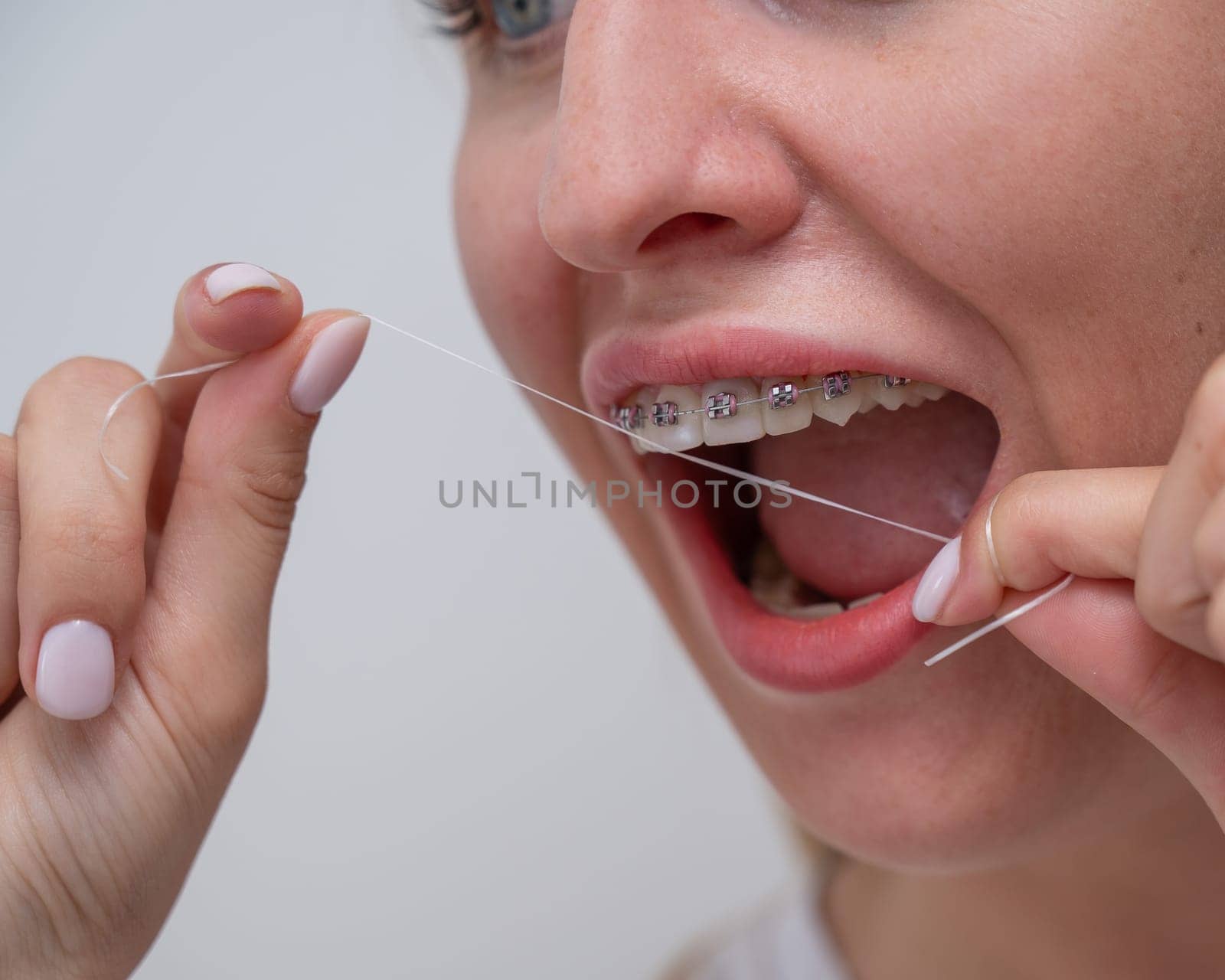 Caucasian woman cleaning her teeth with braces using dental floss. Cropped portrait. by mrwed54