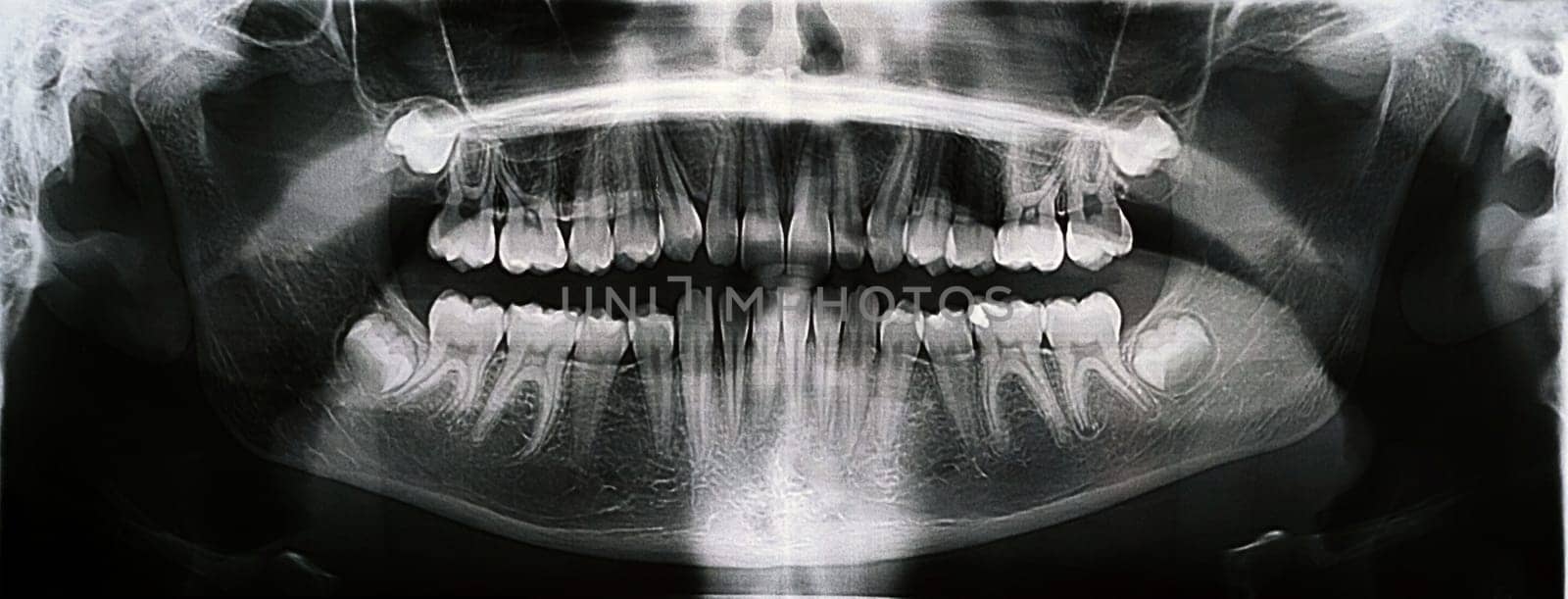 Panoramic X-ray of the jaw. X-ray of the teeth of a 12-year-old girl.