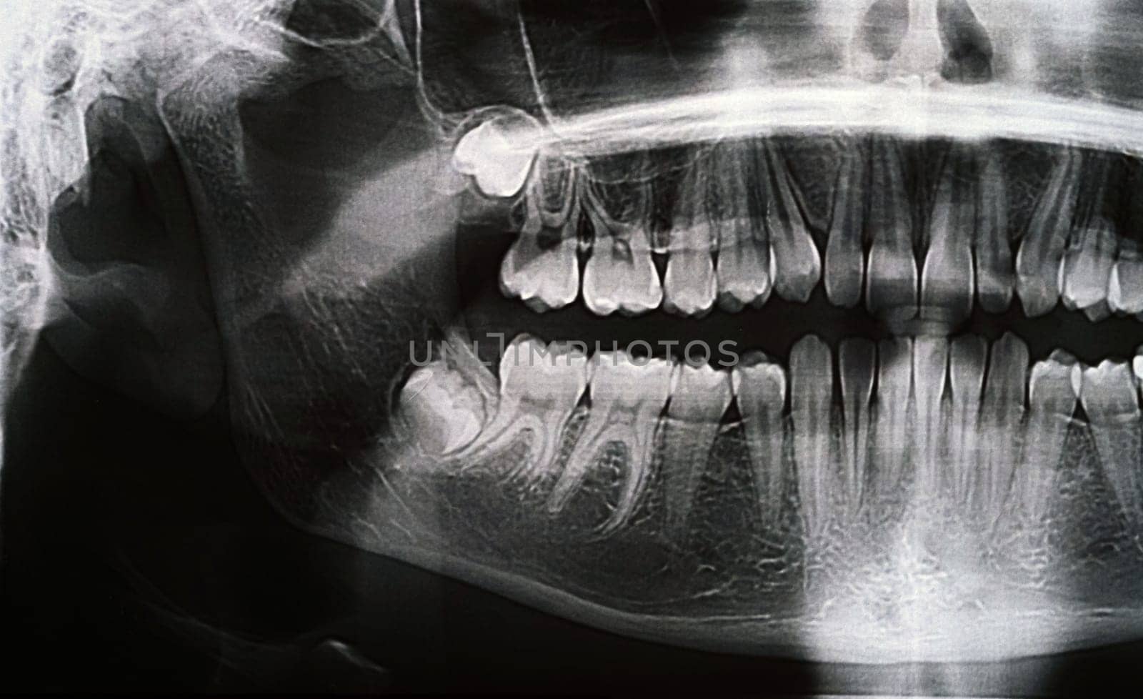 Panoramic X-ray of the jaw. X-ray of the teeth of a 12-year-old girl.