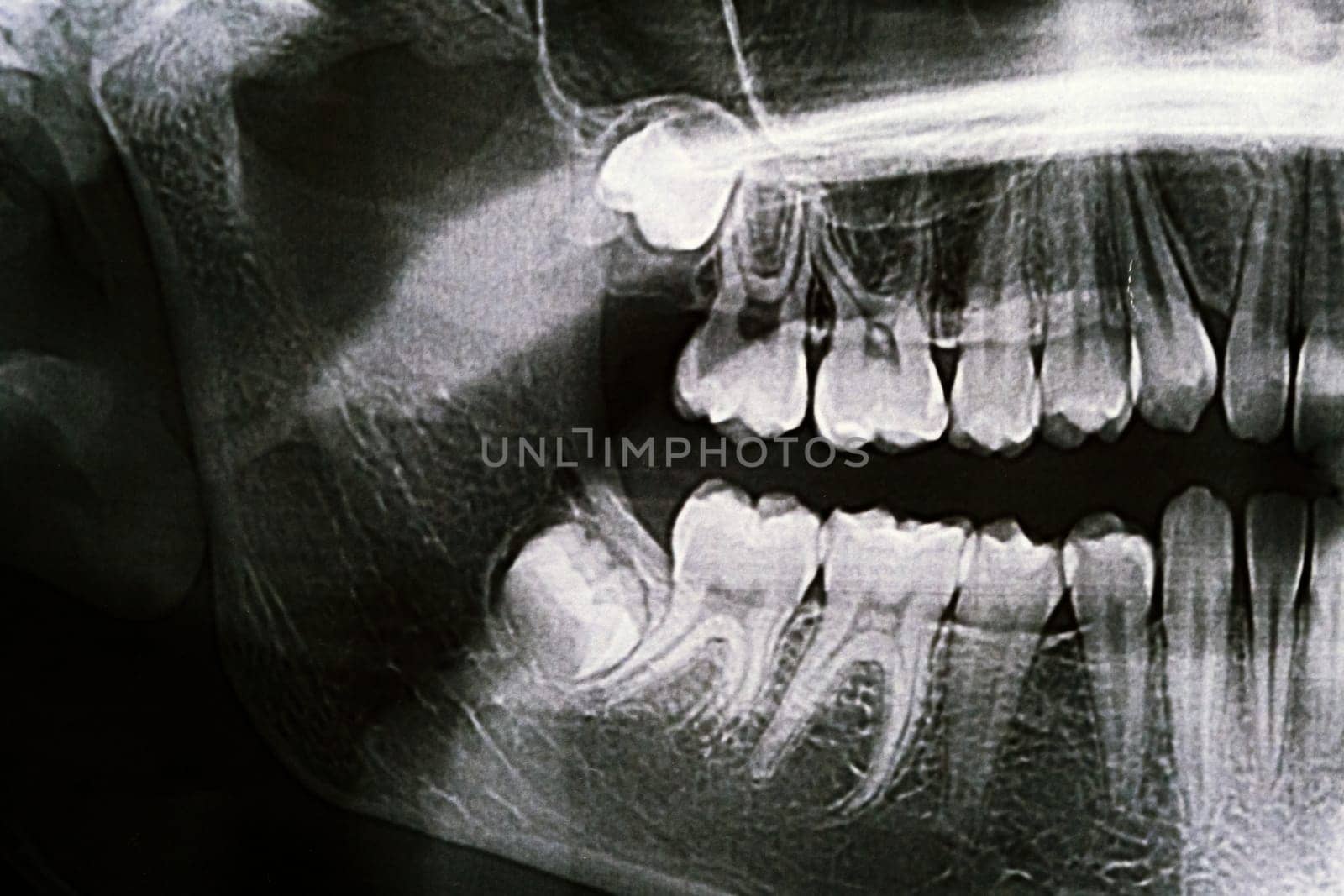 Panoramic X-ray of the jaw. X-ray of the teeth of a 12-year-old girl by Lobachad