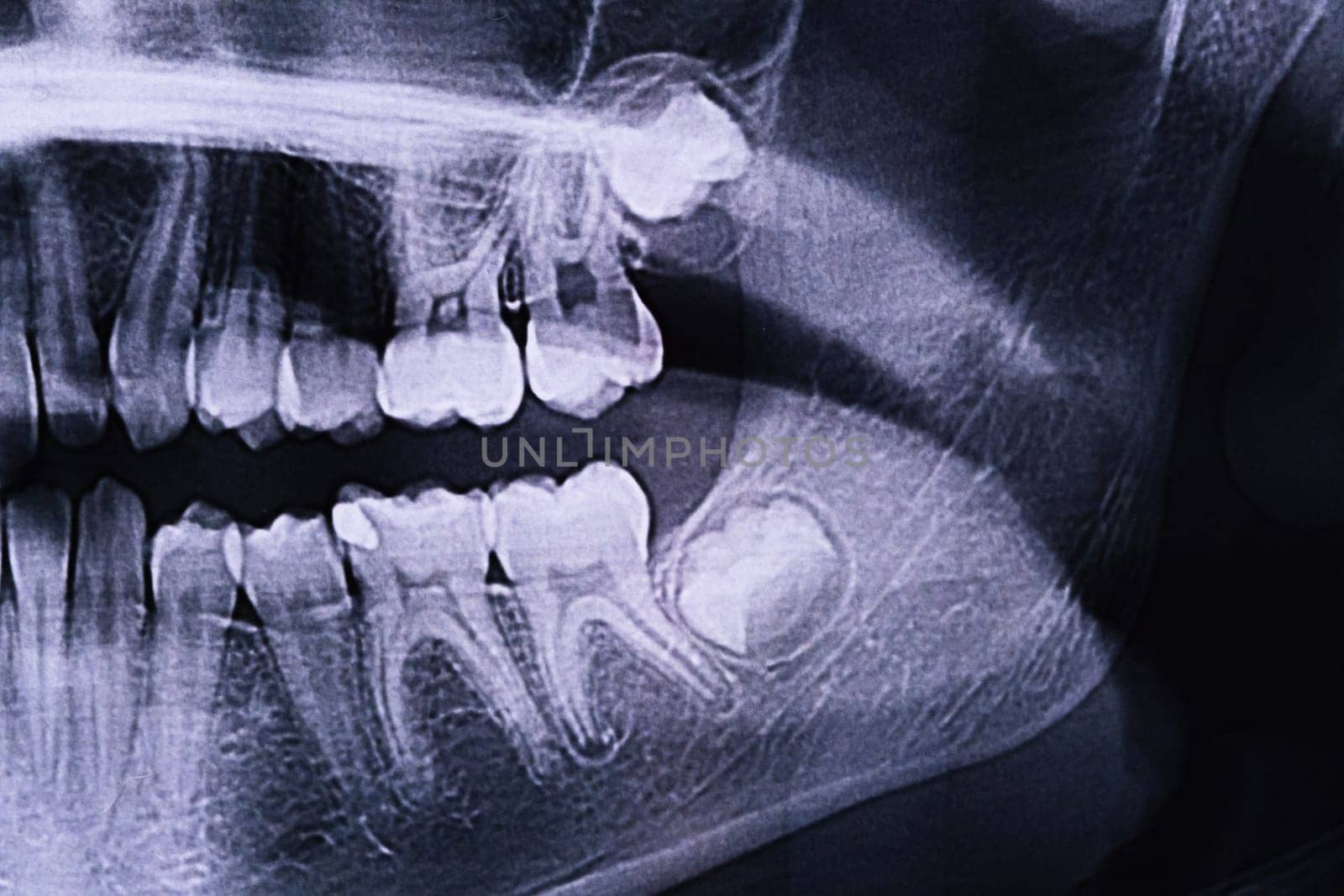 Panoramic X-ray of the jaw. X-ray of the teeth of a 12-year-old girl by Lobachad