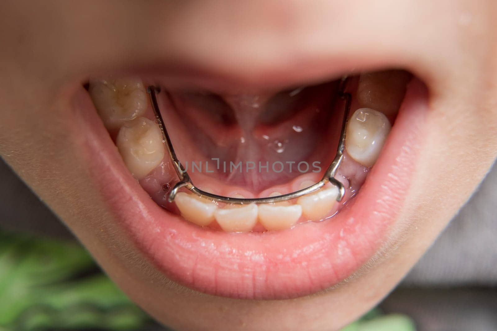 young boy showing off his lingual side dental space maintainer