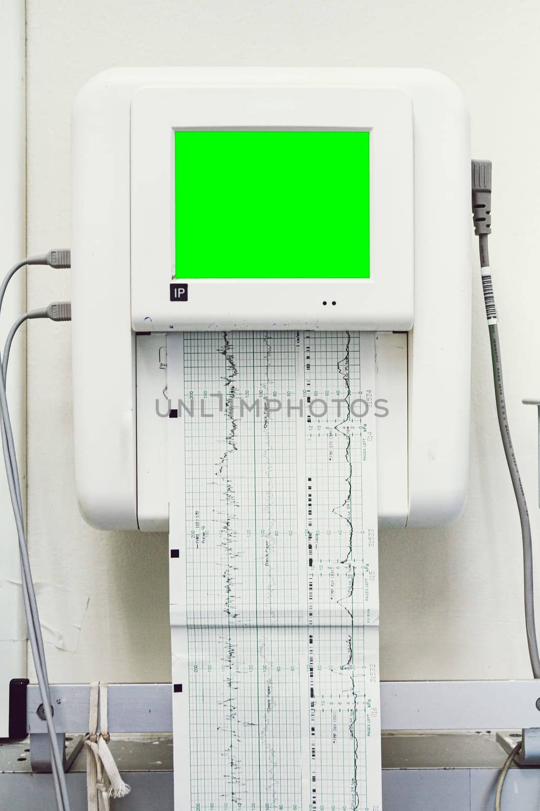 Close up of a fetal monitor or non stress test printing baby heartbeats, electrocardiograph and mother uterine contraction in Labor and delivery room at hospital. Mock up screen.