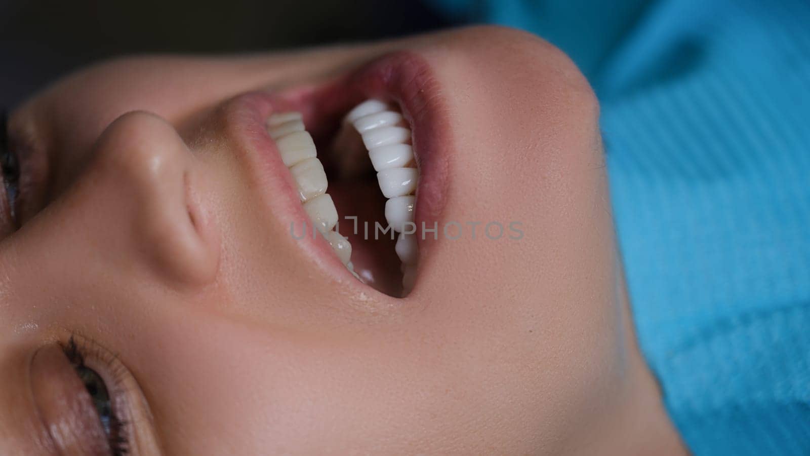 Patient with open mouth with veneers on lower jaw at visit at dentist closeup. Dental prosthetics concept