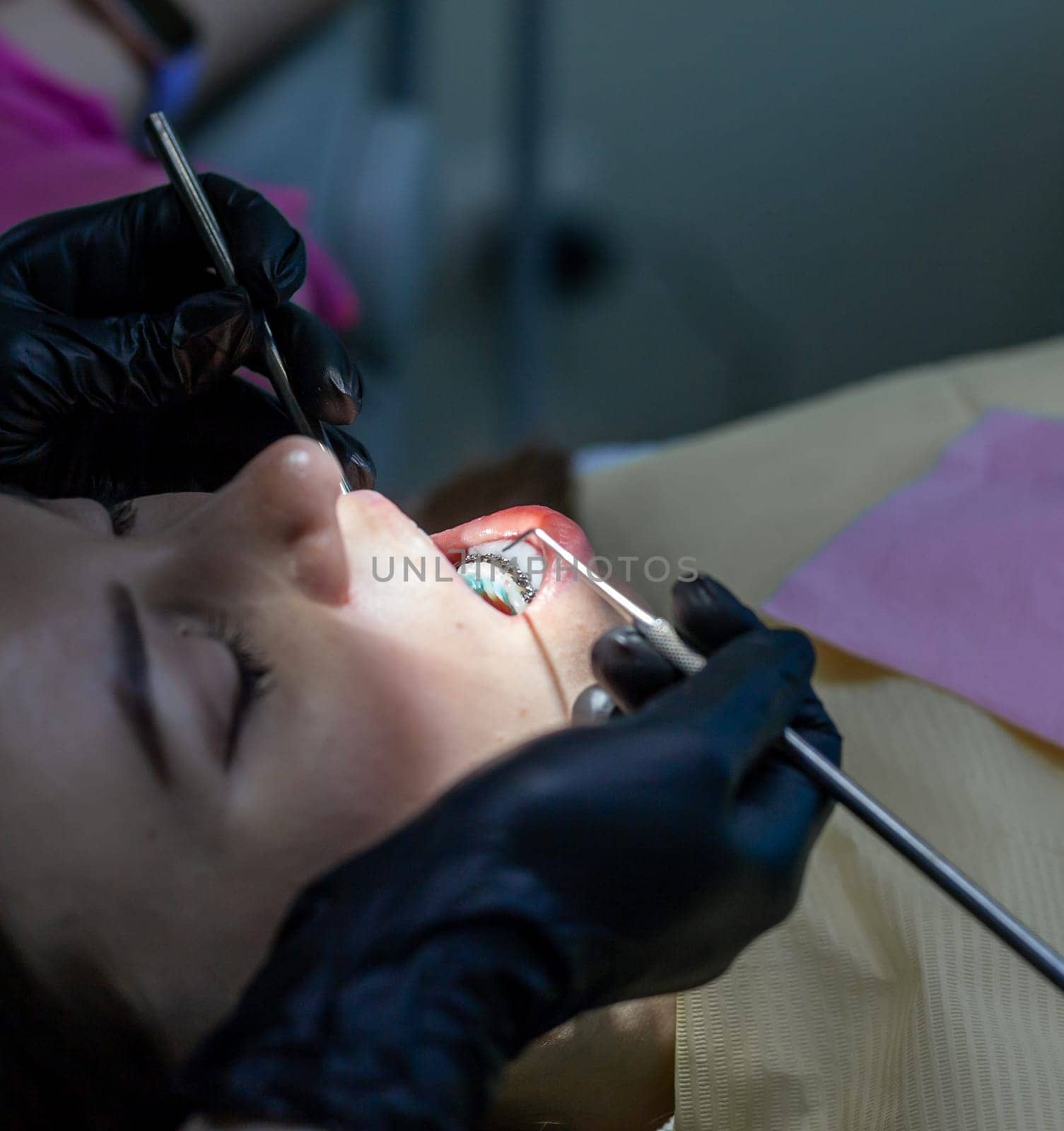 The process of removing braces.Beautiful woman in dental chair during procedure of installing braces to upper and lower teeth. Dentist and assistant working together, dental tools in their hands.