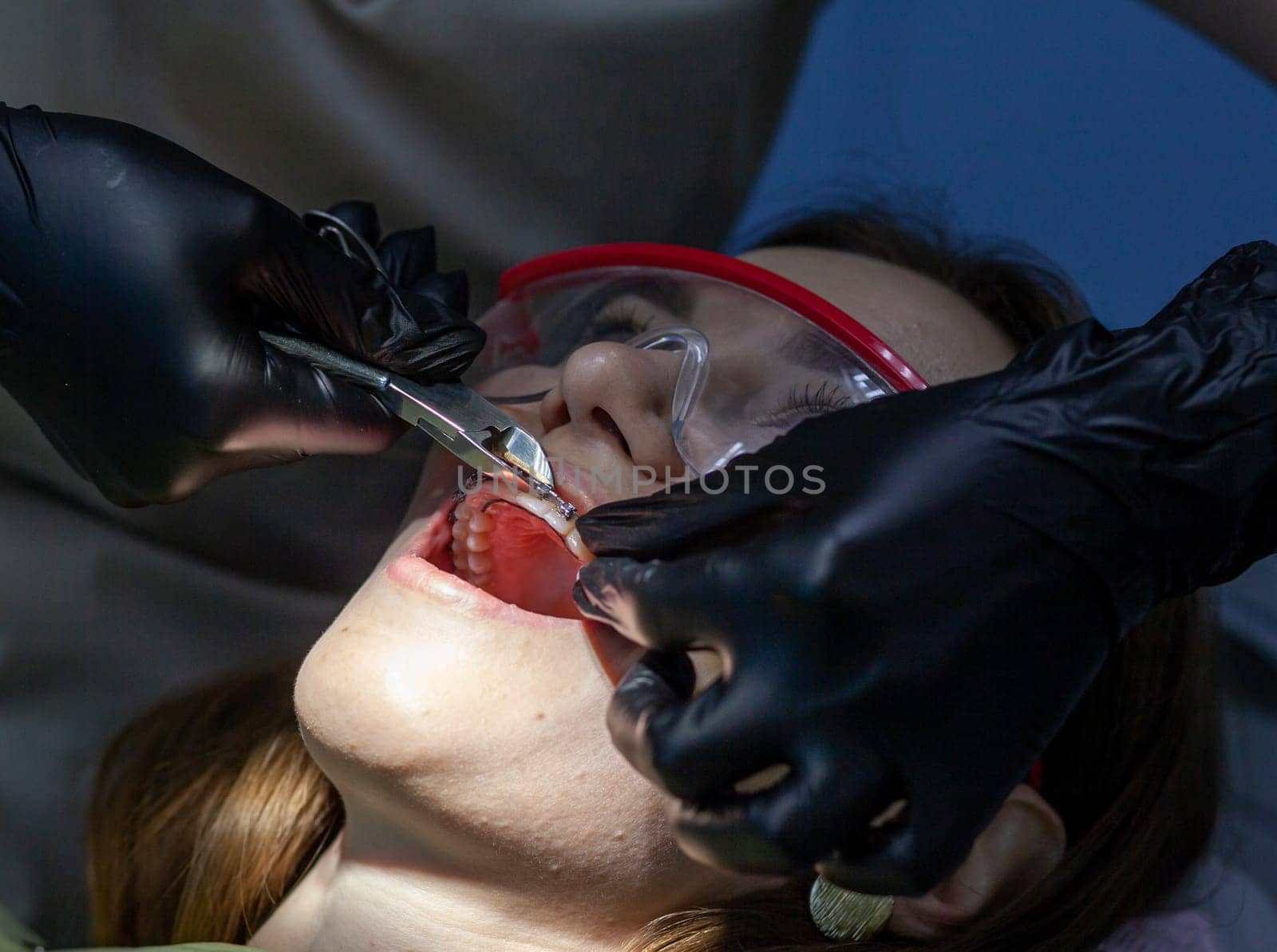 The process of removing braces. A beautiful woman in protective glasses in a dental chair during the procedure of removing braces from teeth. Dentist and assistant working.
