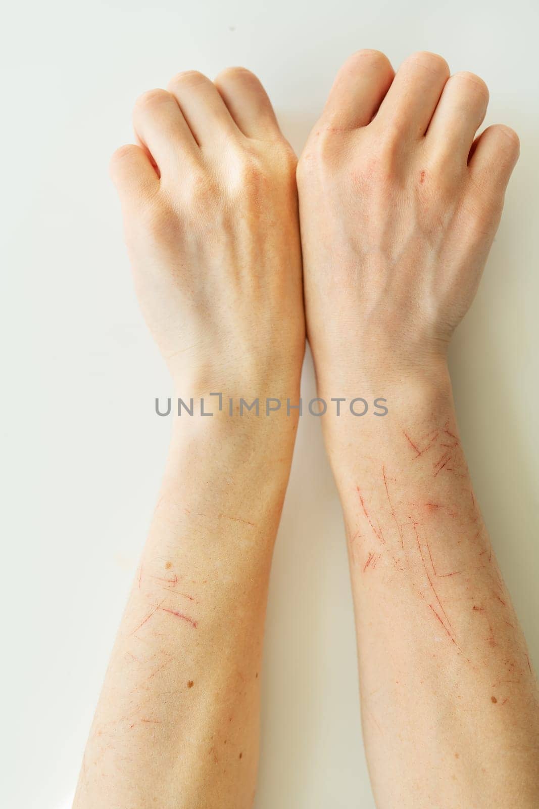 The person is scratched all over, dry skin on the arm, wounds on the arm, scars, psoriasis vulgaris, eczema or other skin diseases. Miscellaneous autoimmune genetic disease