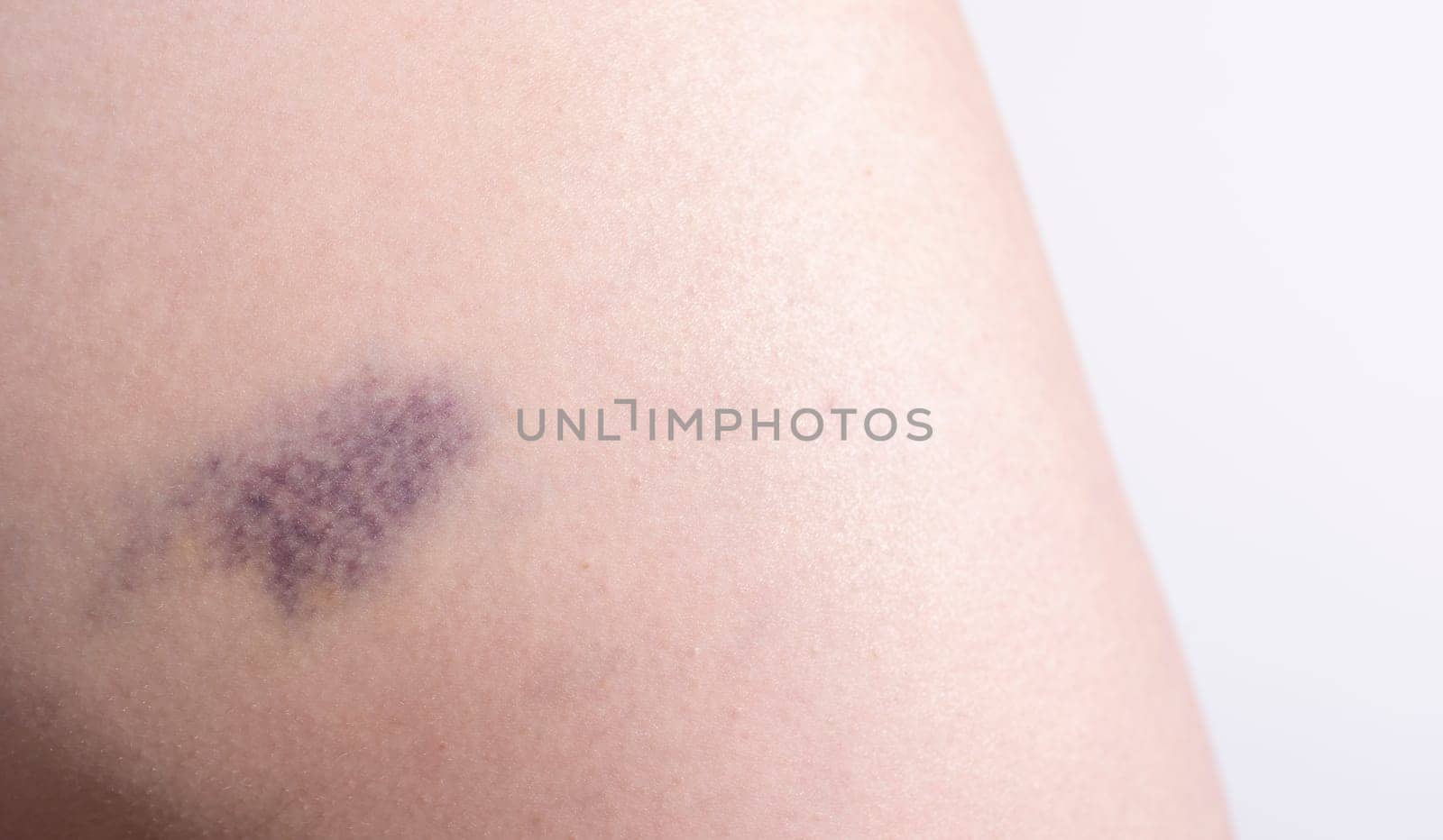 Closeup Blue Purple Hematoma, Bruise On Thigh, Hip After Trauma, Fall. Horizontal plane. Clotted Blood, Injury On Human Body Concept. Copy Space For Text. High quality photo
